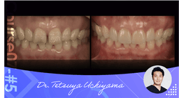 #5 Table top venner, clinical case