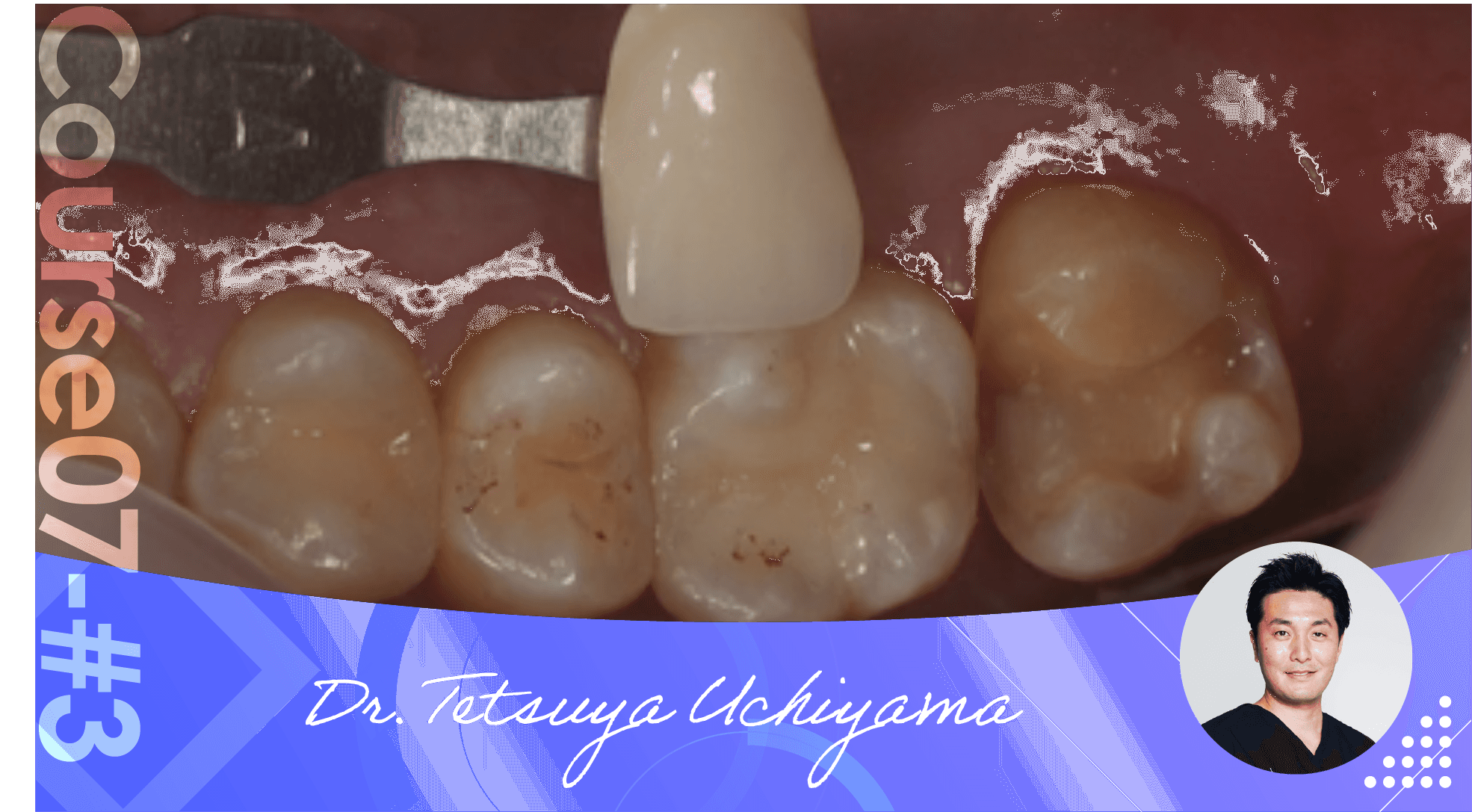 #3 Composite Resin Filling, clinical case (resin filling)