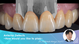 Anterior Defects ~How would you like to plan~