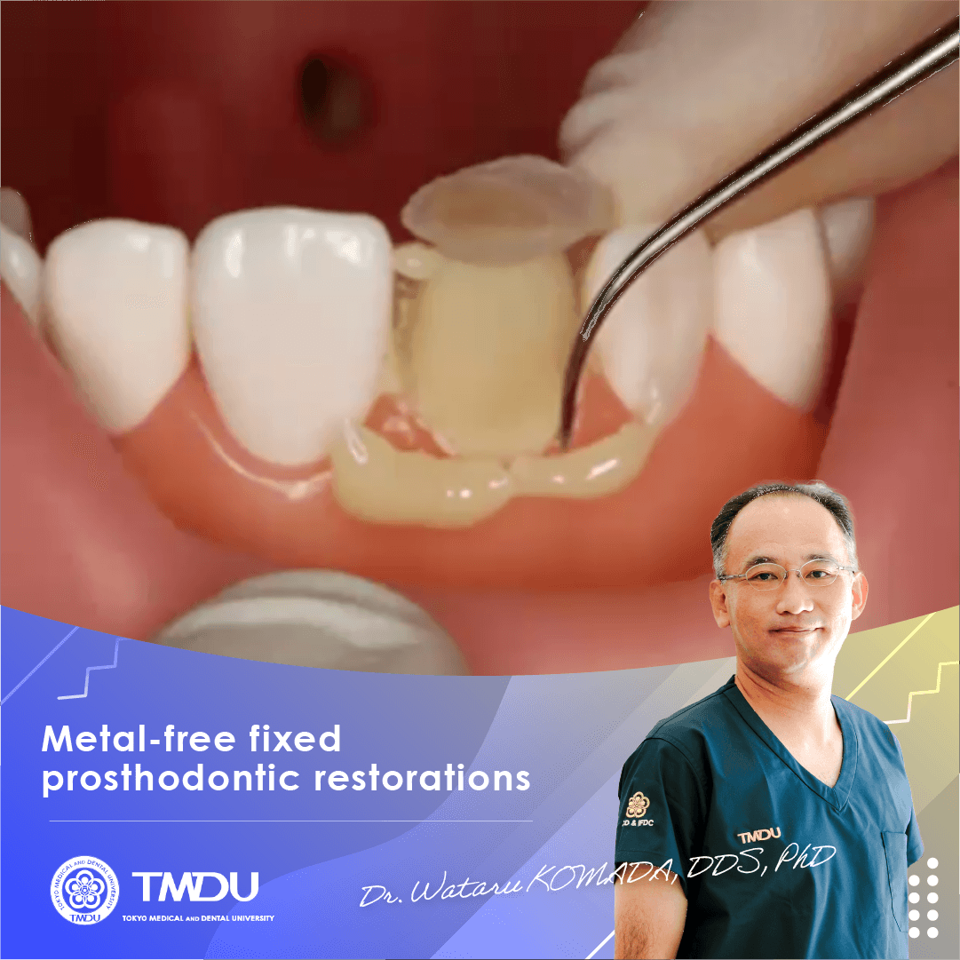 Metal-free fixed prosthodontic restorations