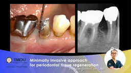 Minimally invasive approach for periodontal tissue regeneration