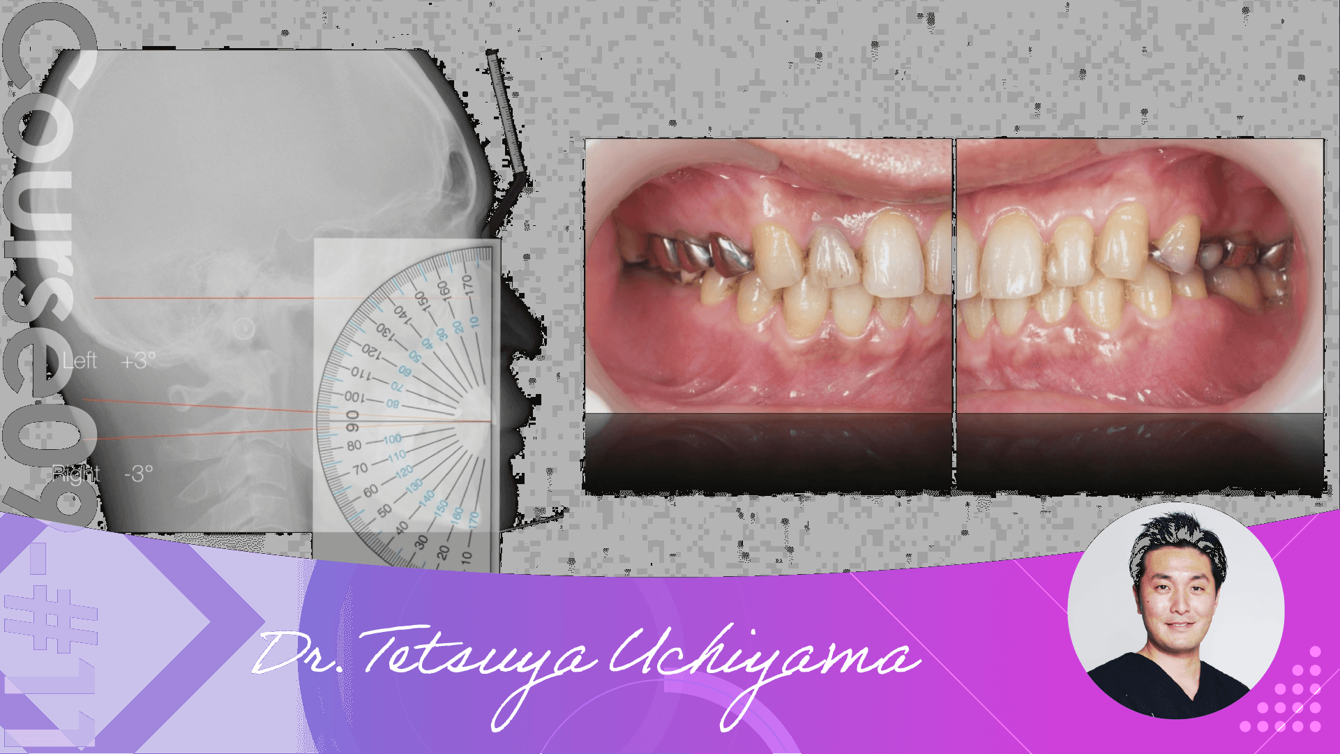 #11 Occlusion and Crown Lengthening