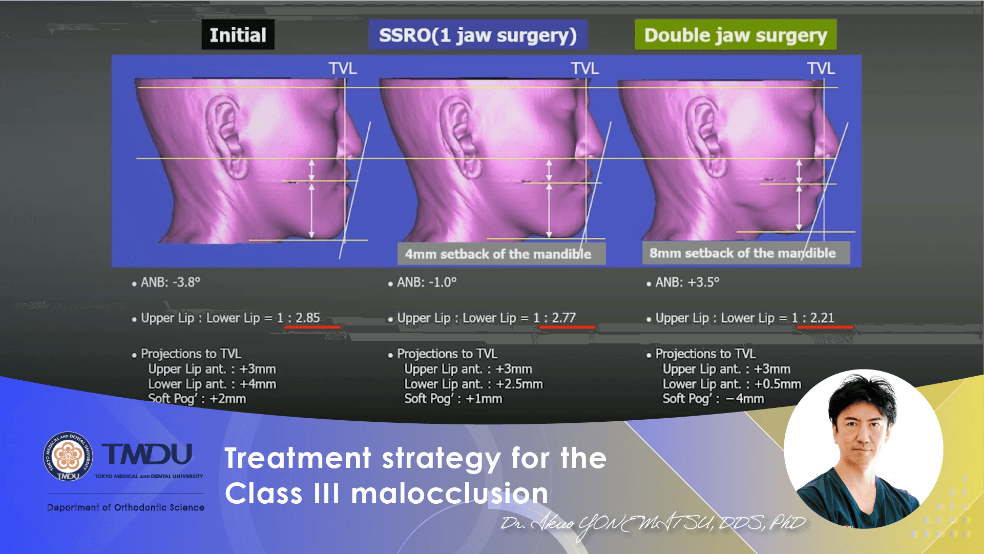 Treatment strategy for the Class III malocclusion