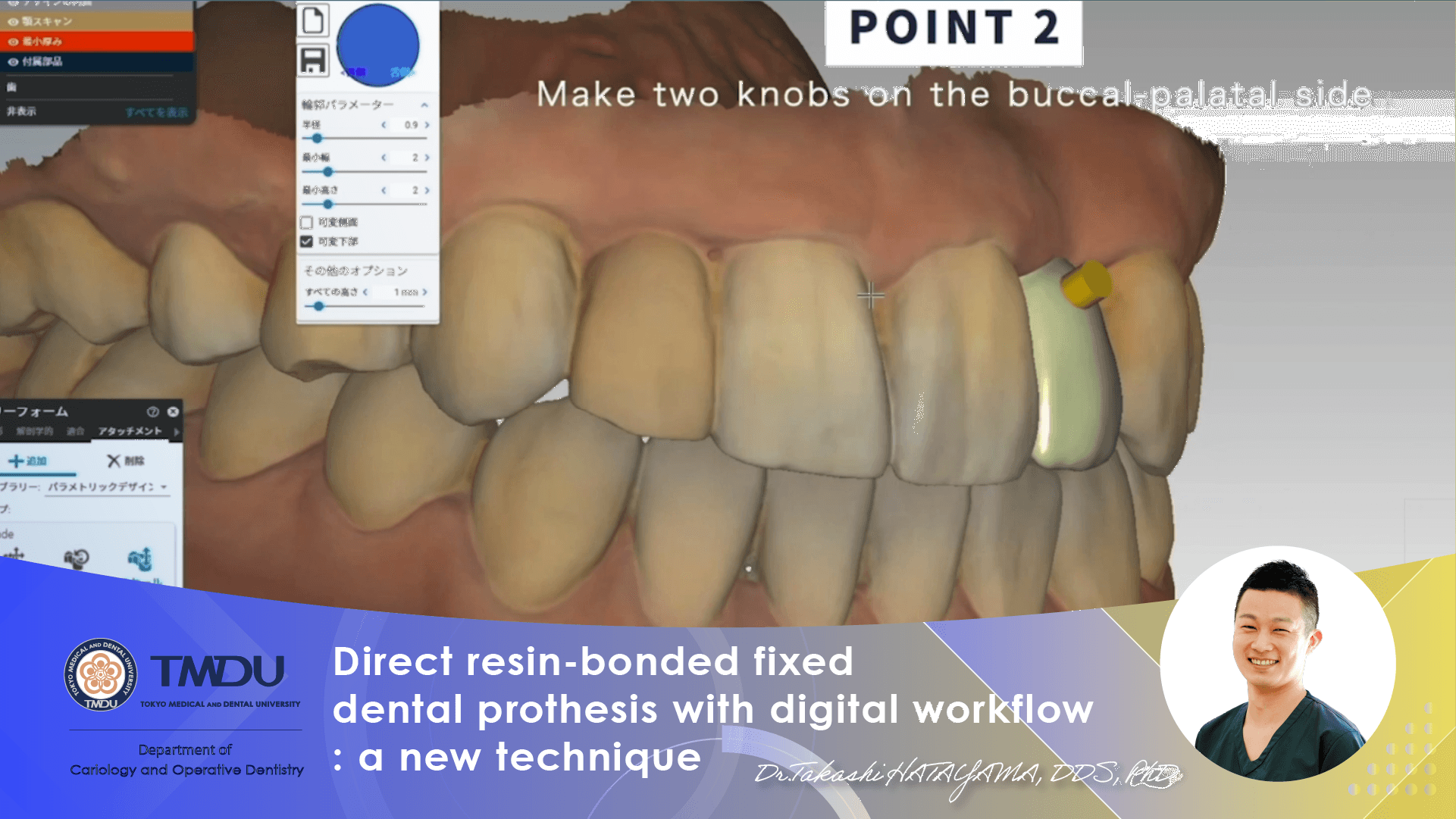 Direct resin-bonded fixed dental prothesis with digital workflow: a new technique