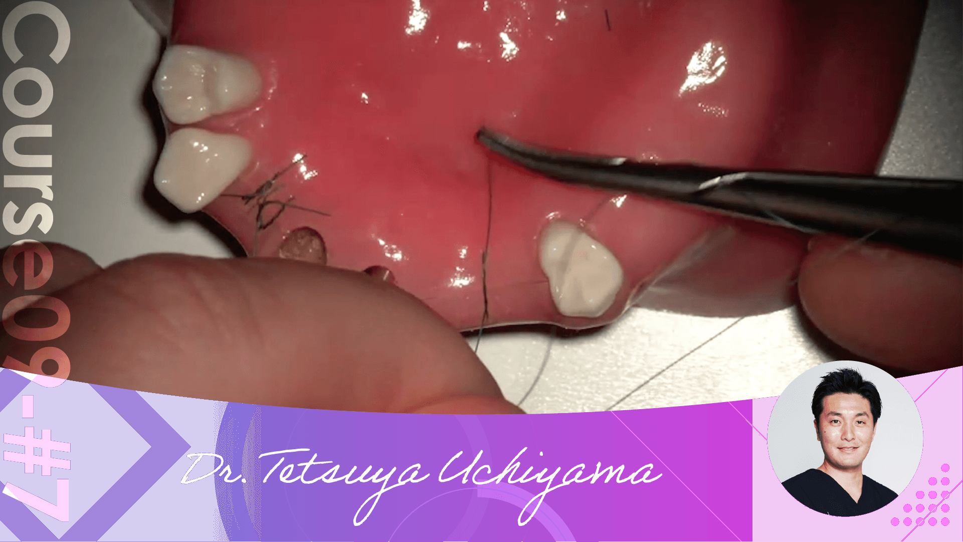 #7 Suture and Final