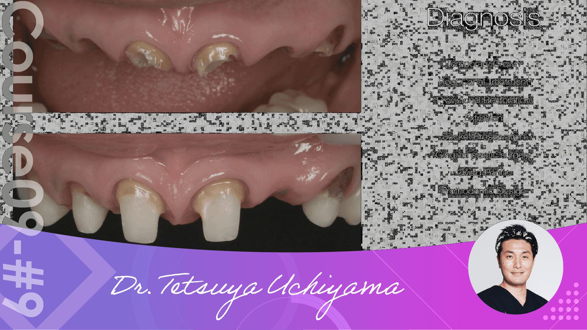 #9 Crown Length Rings and Provisional Restorations