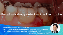 Minimally invasive procedure for periodontal regeneration therapy  using erbium YAG laser. －Development of new surgical technique L-EPPT－