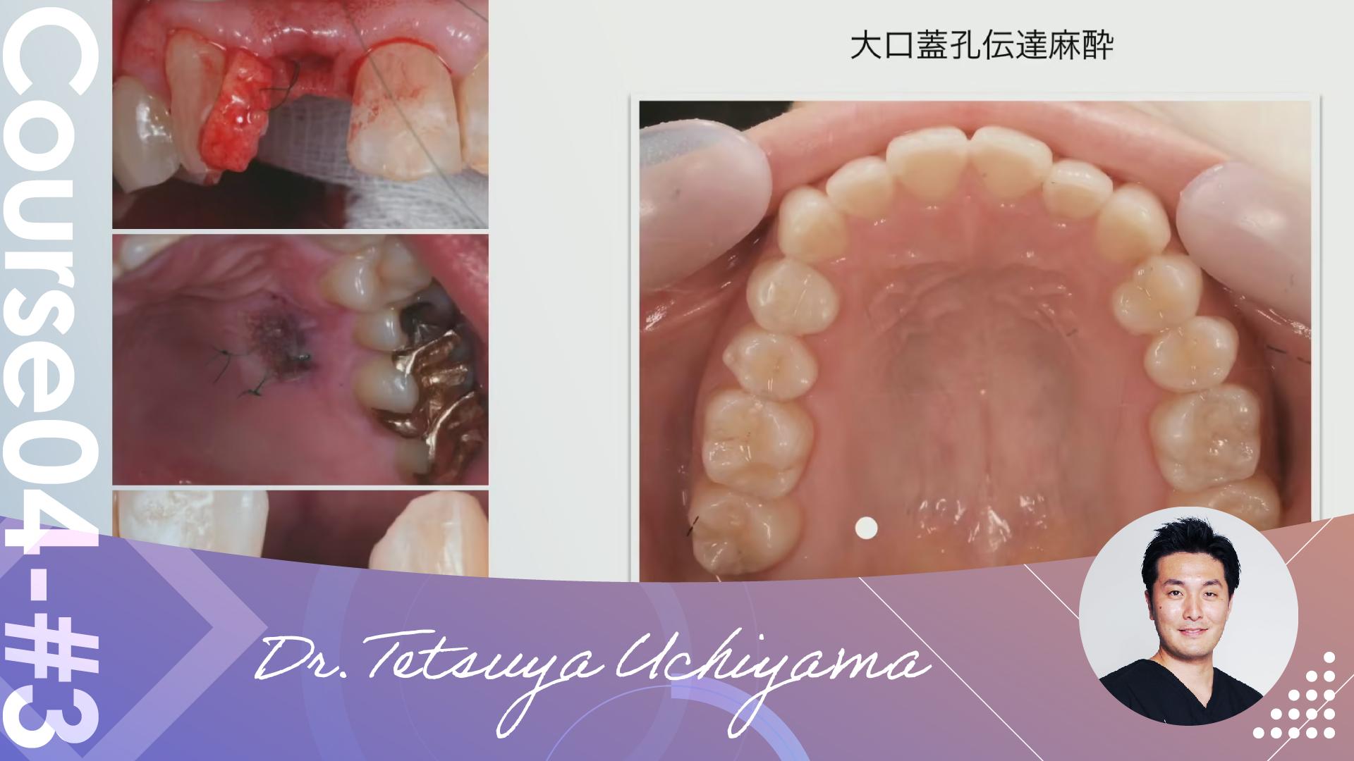 #3 Various methods of administering transmissible anesthesia