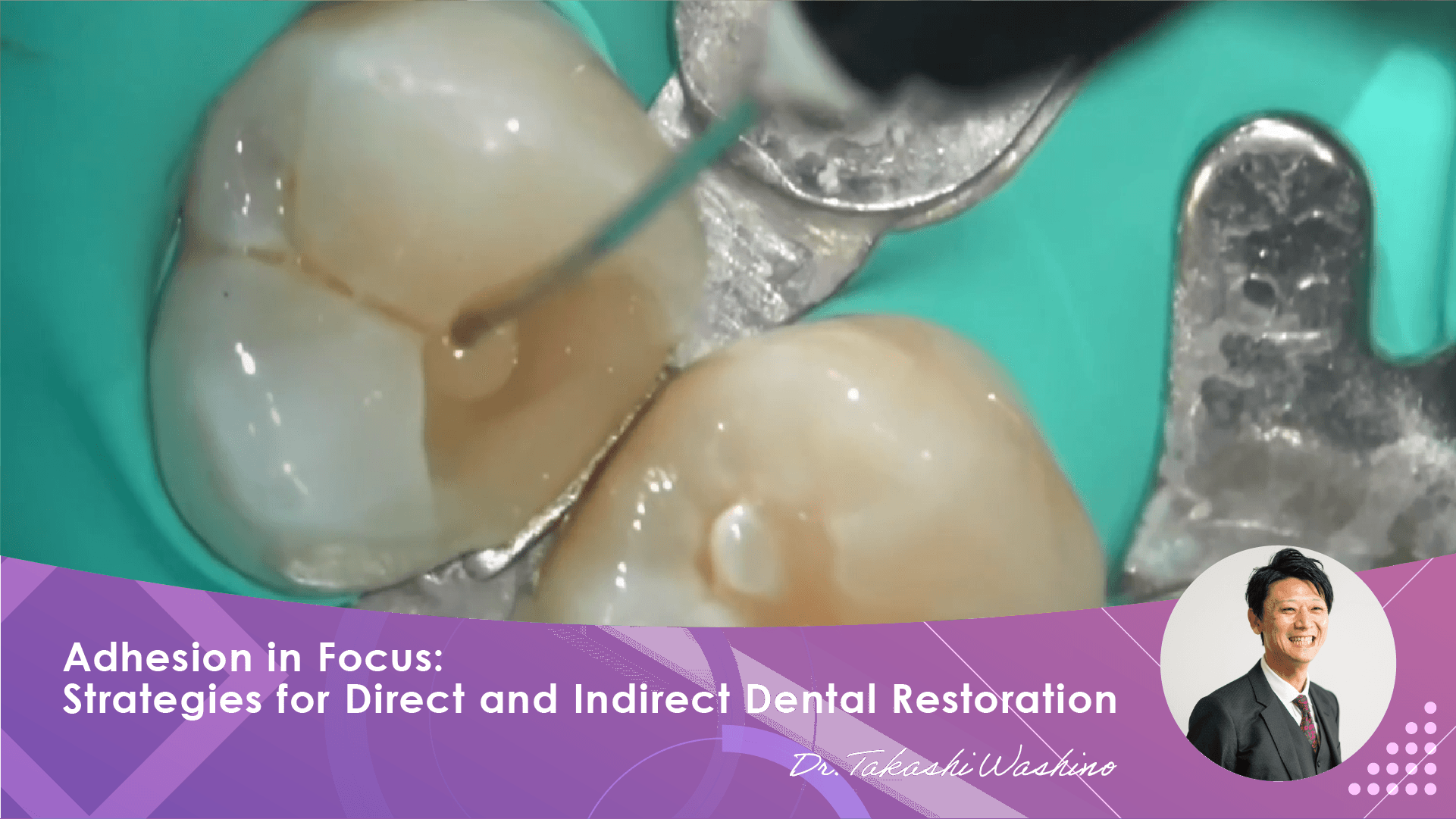 【Free to Watch】Adhesion in Focus:Strategies for Direct and Indirect Dental Restoration