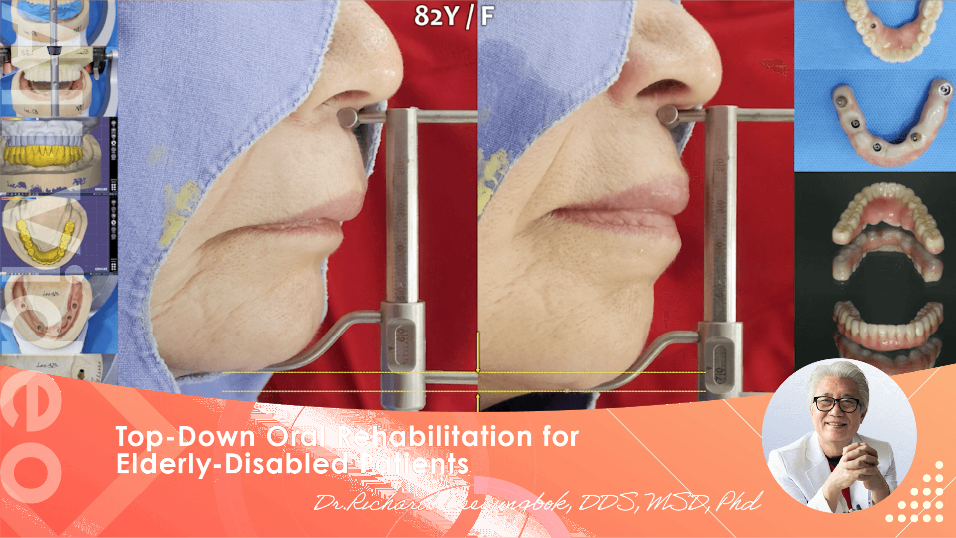 Top-Down Oral Rehabilitation for Elderly-Disabled Patients [Full course module 1~5]　