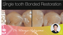 #1 Bonded Restoration, the advantages of using micro for bonding