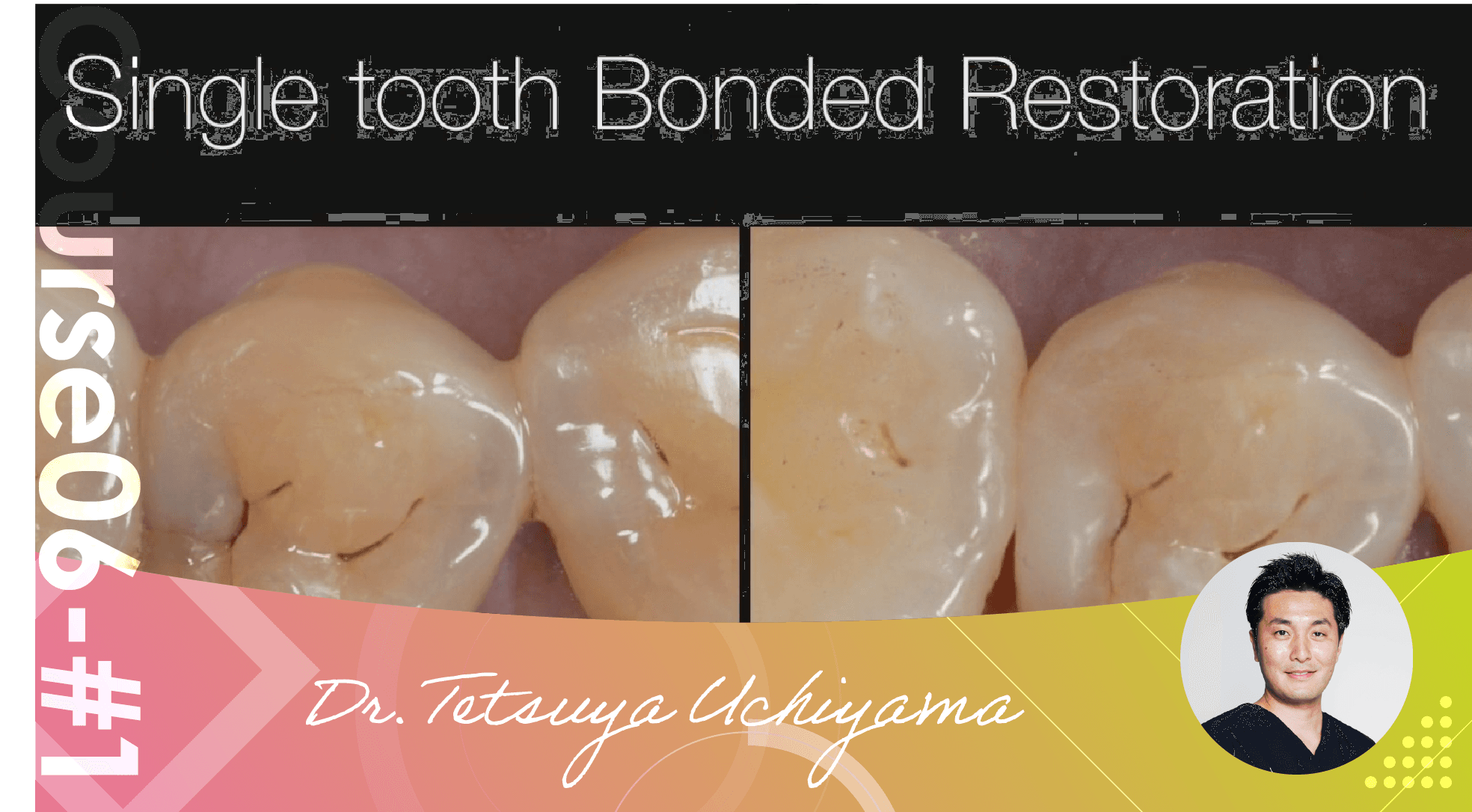 #1 Bonded Restoration, the advantages of using micro for bonding