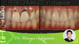 #1 Advanced bonded restoration with little or no tooth reduction