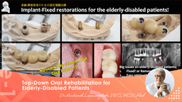 （Free to Watch）Overview of Top-Down Implant Treatment Implant treatment in elderly disabled patients strategy & planning