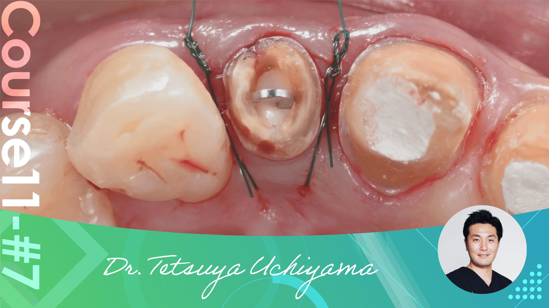 #7 Approach to a hopeless tooth with no ferrule and coloration