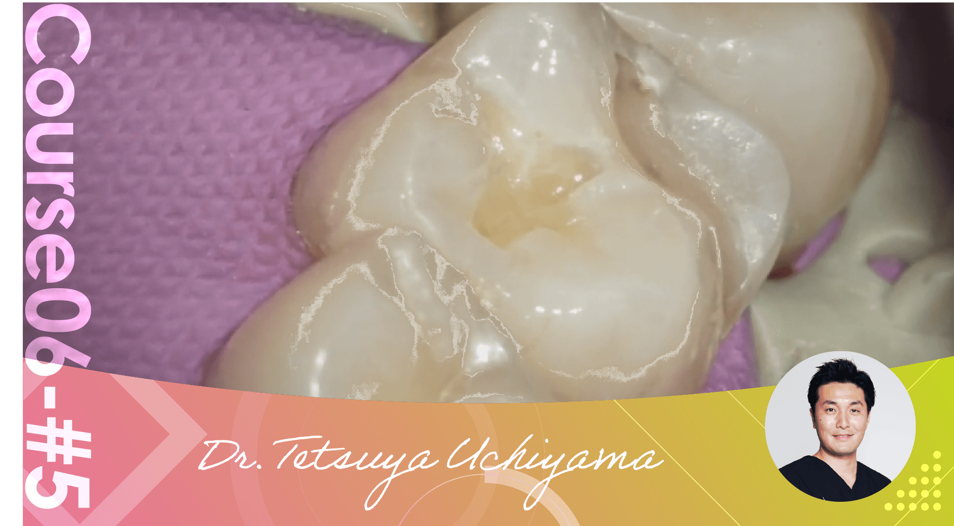 #5 Tunneling Technique, clinical case (retreatment of adjacent CR)