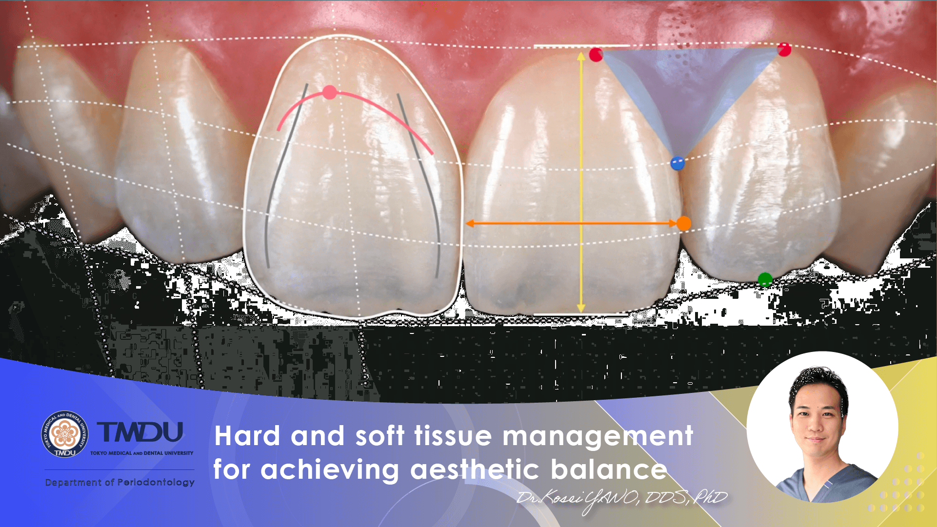 Hard and soft tissue management for achieving aesthetic balance