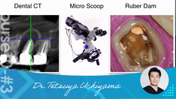 #3 Causes of root apex lesions