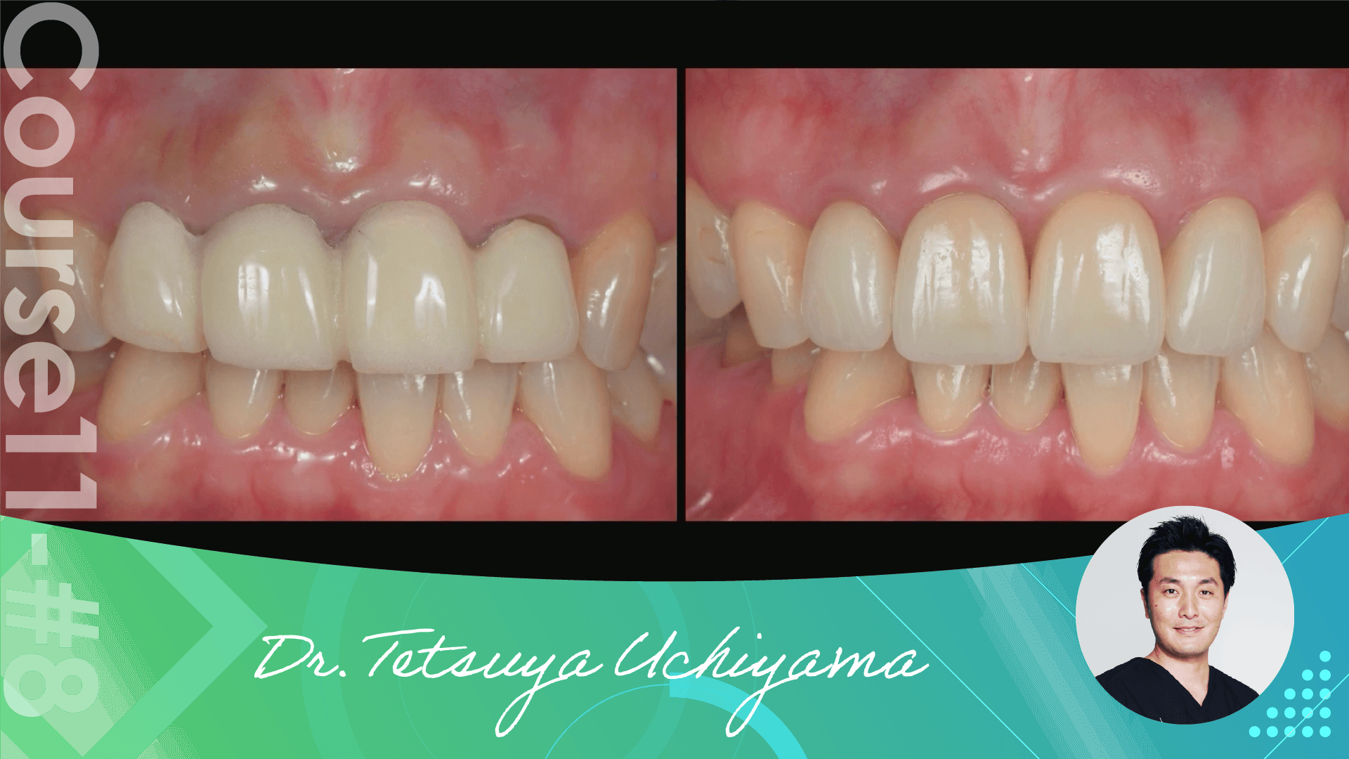 #8 Root Canal Filling of Case Presentation 3 - Final