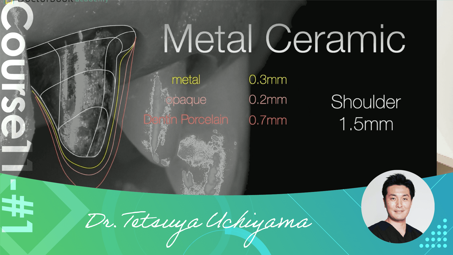 #1 Comprehensive Abutment Procedure overview case presentation