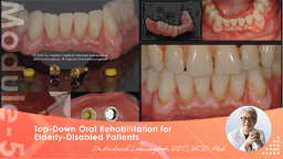 Case Presentation on All-on-X Prostheses #2: Selection of Abutment, Prosthetic type, Definitive Materials, Future Direction & Recommendations and Conclusion