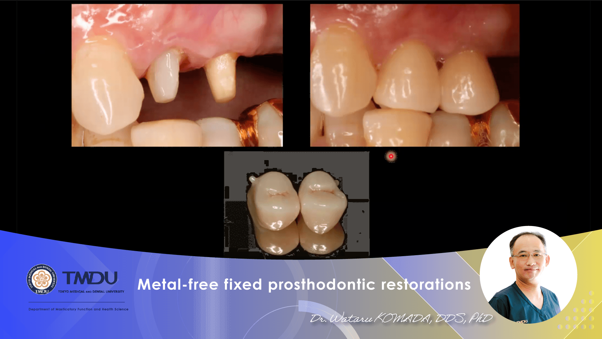 Metal-free fixed prosthodontic restorations