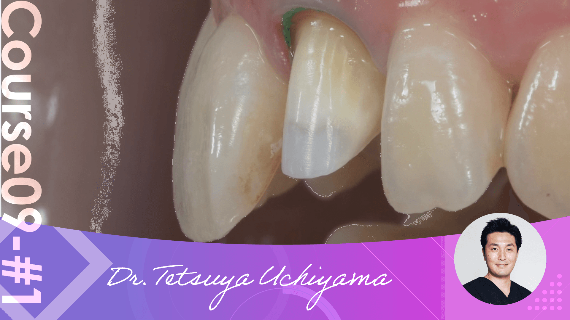 #1 Understanding the Dentogingival Complex