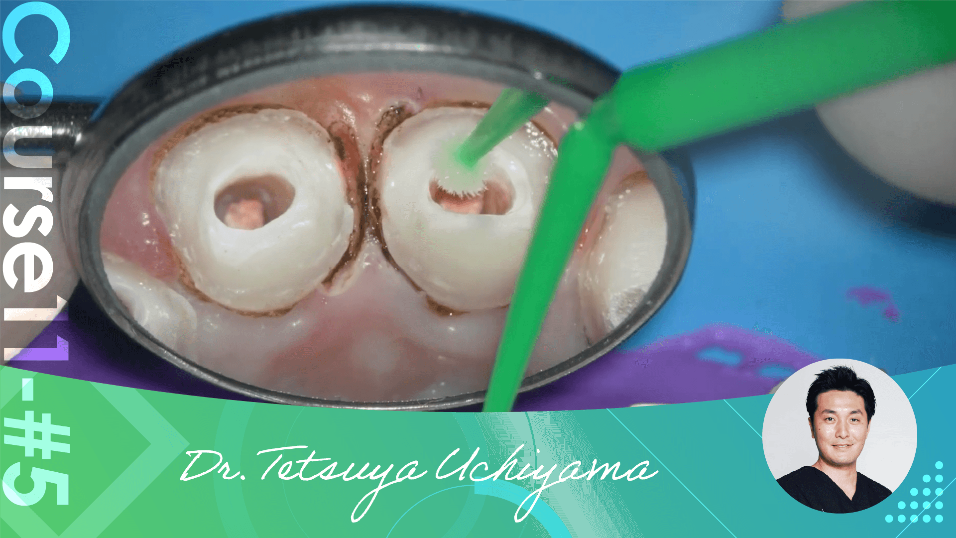 #5 Methods of resin core and Preparation of abutment teeth