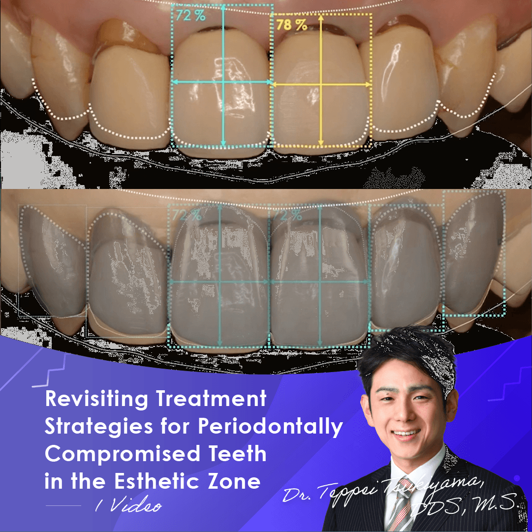 Revisiting Treatment Strategies for Periodontally Compromised Teeth in the Esthetic Zone