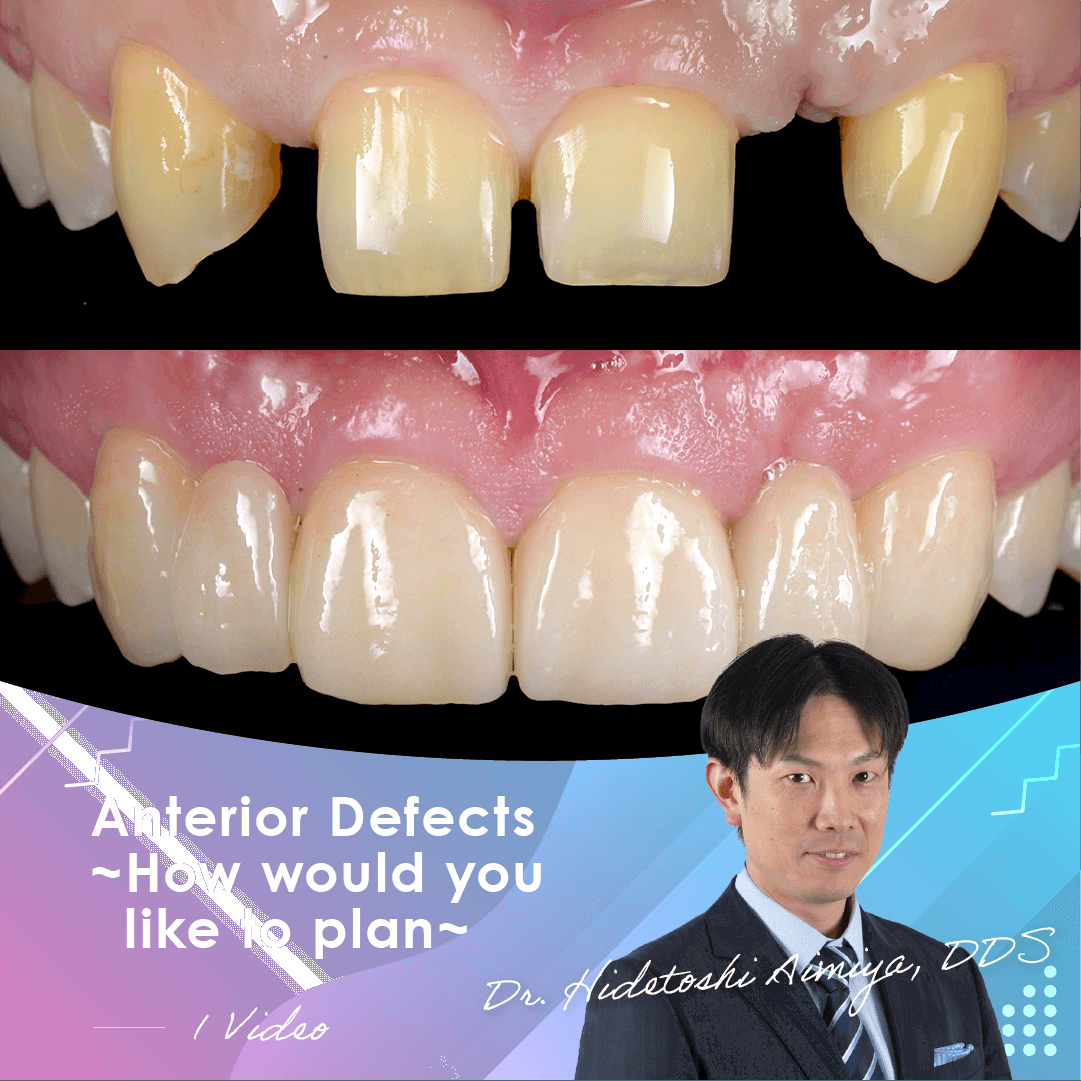 Anterior Defects ~How would you like to plan~