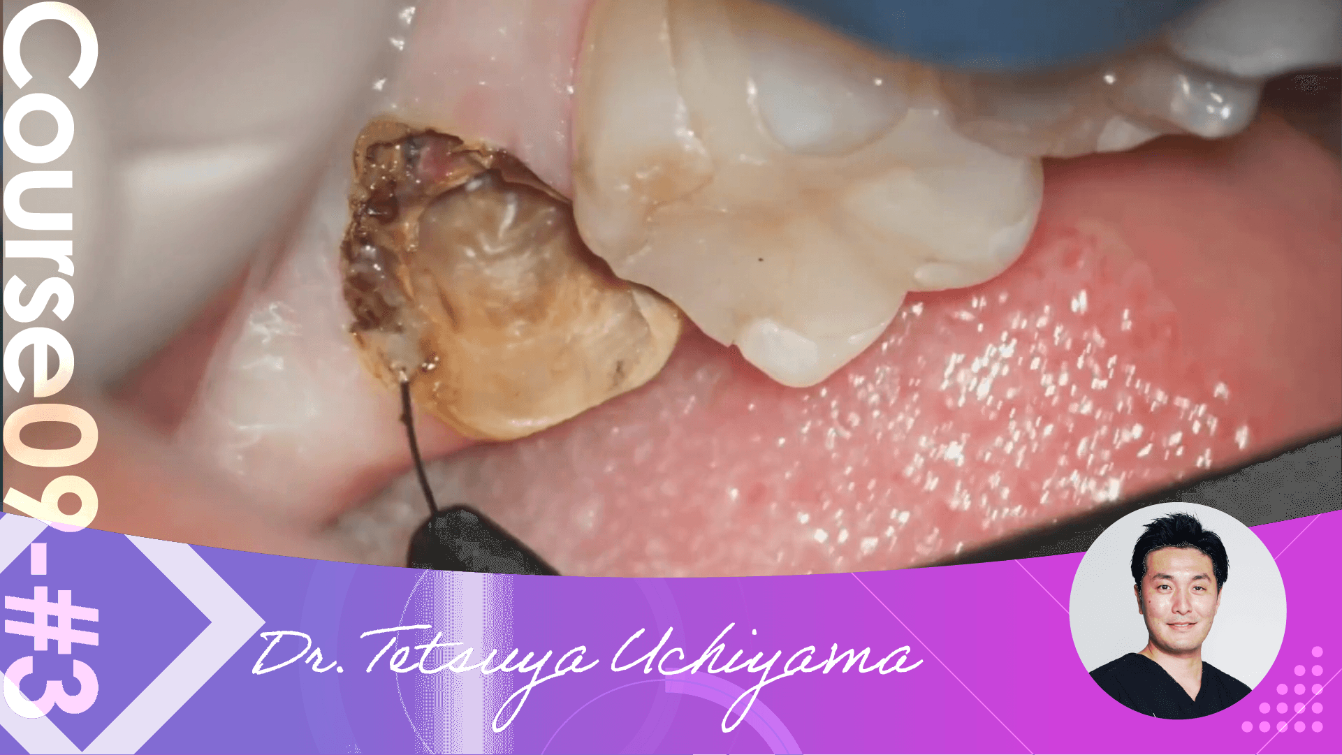 #3 Facing Hemostasis