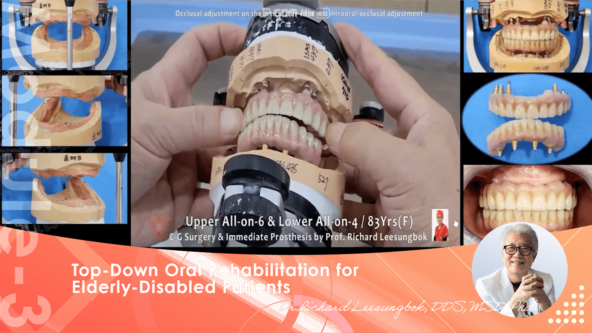Elderly edentulous transition from Complete Dentures to Fixed hybrid prostheses, Mutually Protected Occlusion for Fixed Prostheses and Considerations
