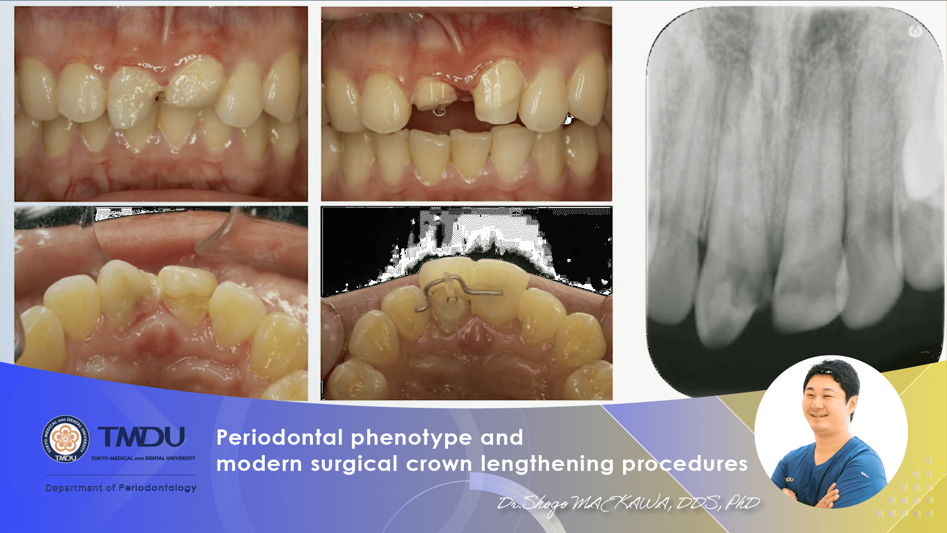Periodontal phenotype and modern surgical crown lengthening procedures