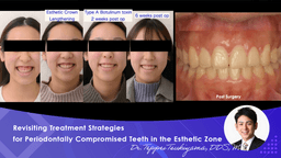 Revisiting Treatment Strategies for Periodontally Compromised Teeth in the Esthetic Zone