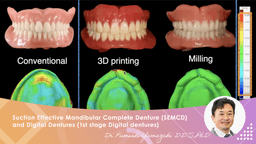 Suction Effective Mandibular Complete Denture (SEMCD) and Digital Dentures (1st stage Digital dentures)
