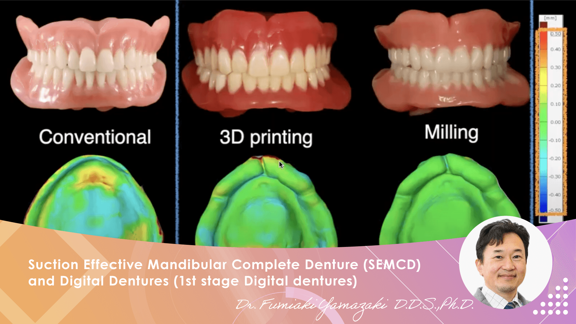 Suction Effective Mandibular Complete Denture (SEMCD) and Digital Dentures (1st stage Digital dentures)