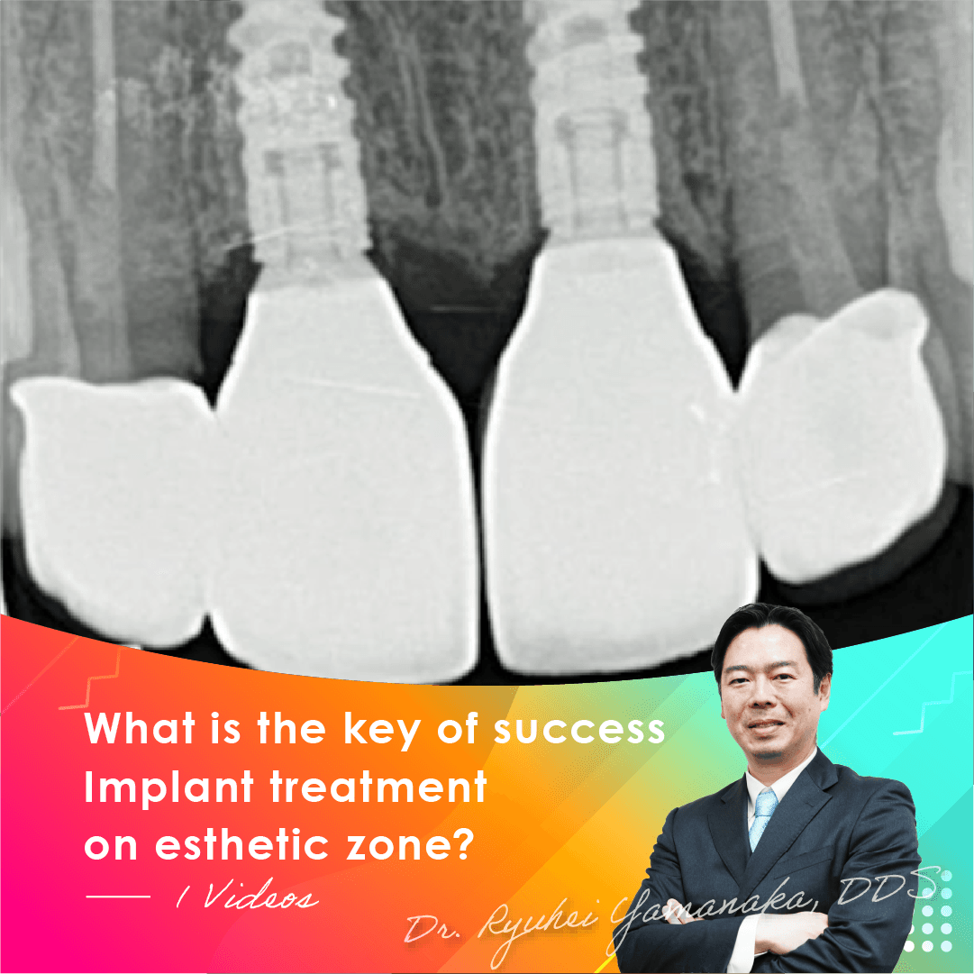 What is the key of success Implant treatment on esthetic zone?