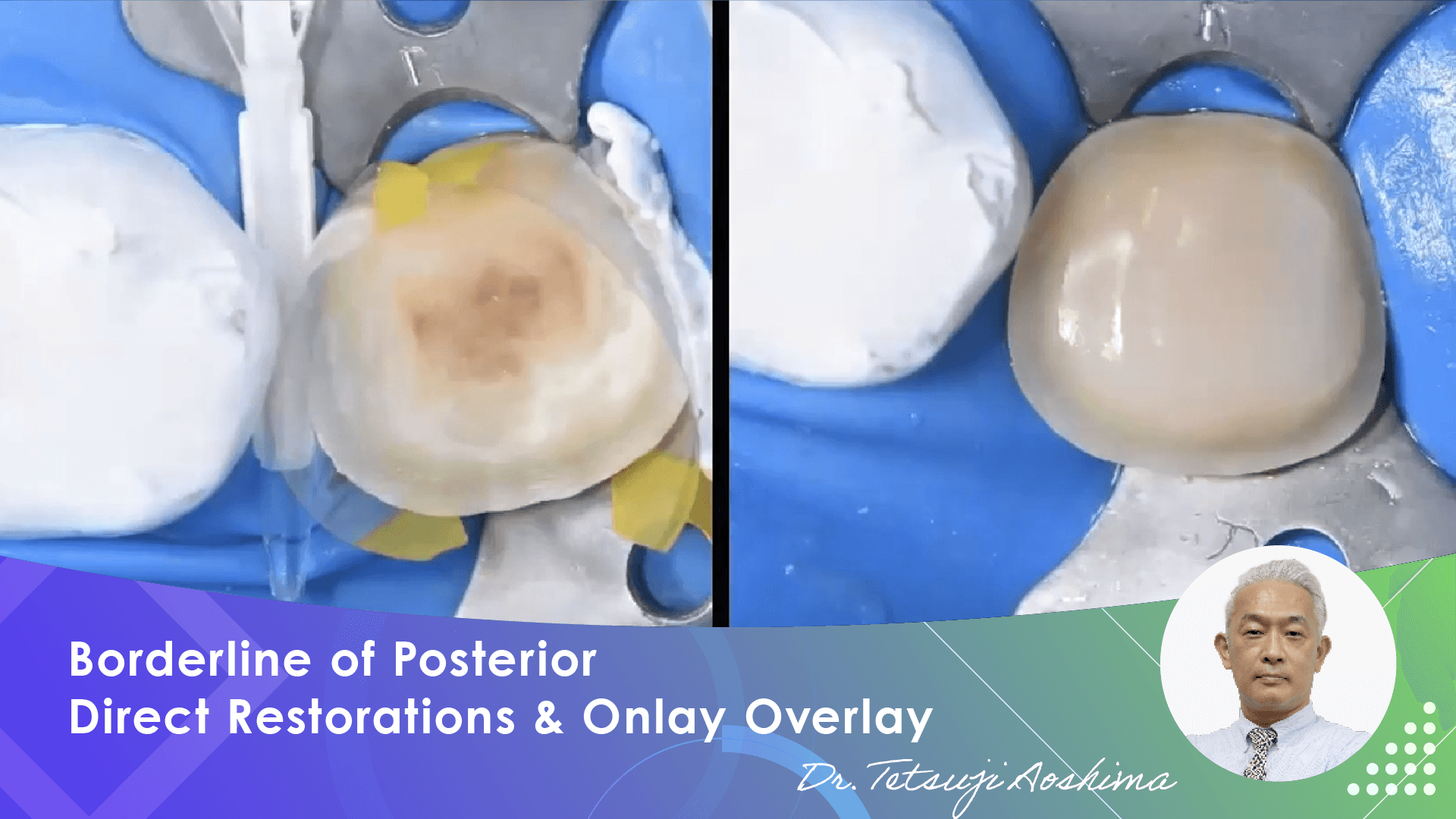 【Sample】Borderline of Posterior Direct Restorations and Onlay Overlay