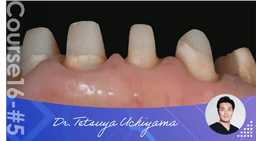 #5 Importance of Occlusion and Tissue Management