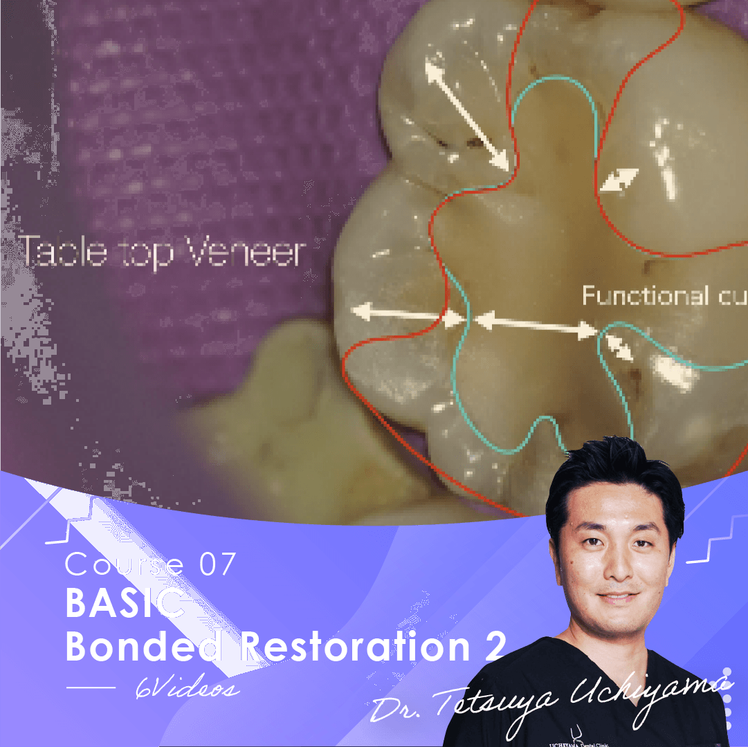 BASIC Bonded Restoration 2