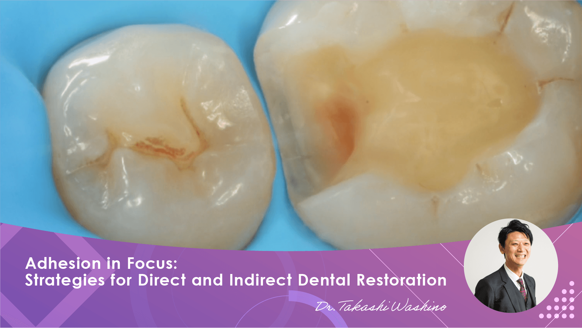 Adhesion in Focus: Strategies for Direct and Indirect Dental Restoration