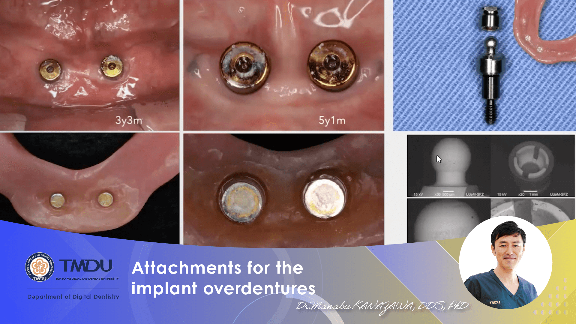 Attachments for the implant overdentures
