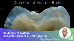 Borderline of Posterior Direct Restorations and Onlay Overlay
