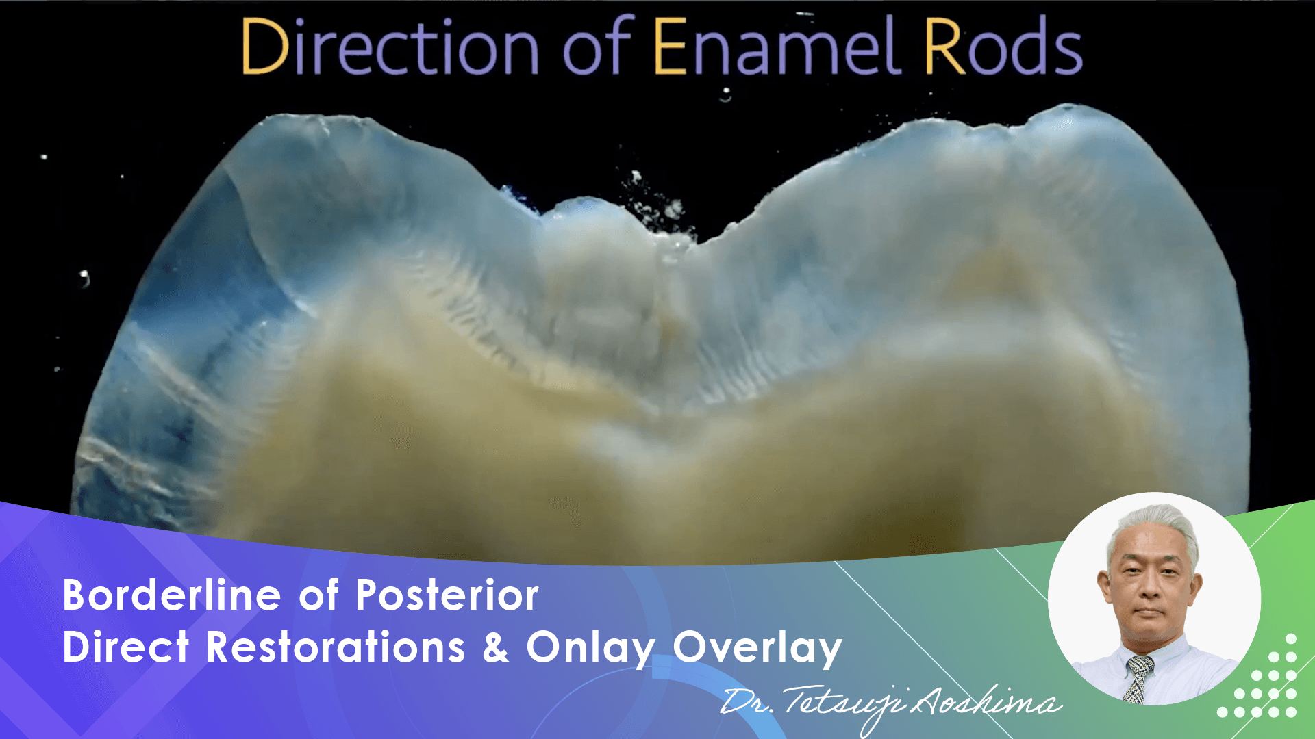 Borderline of Posterior Direct Restorations and Onlay Overlay