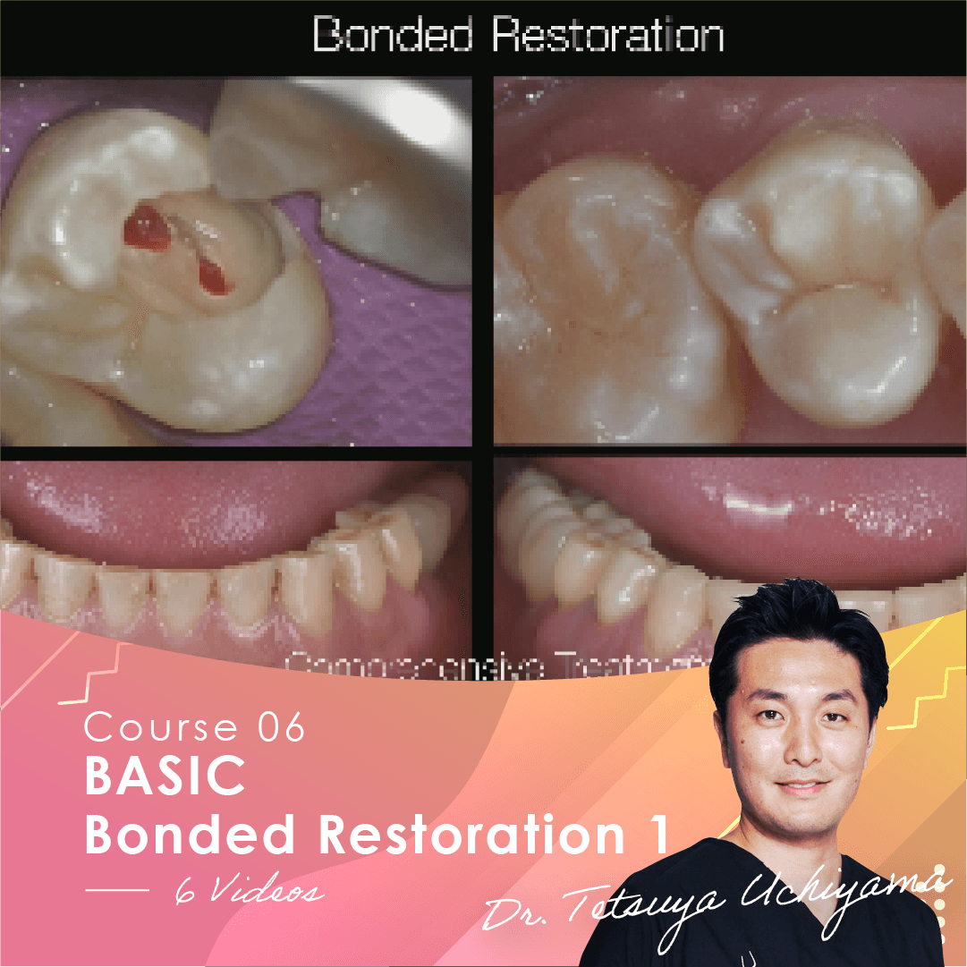 BASIC Bonded Restoration 1