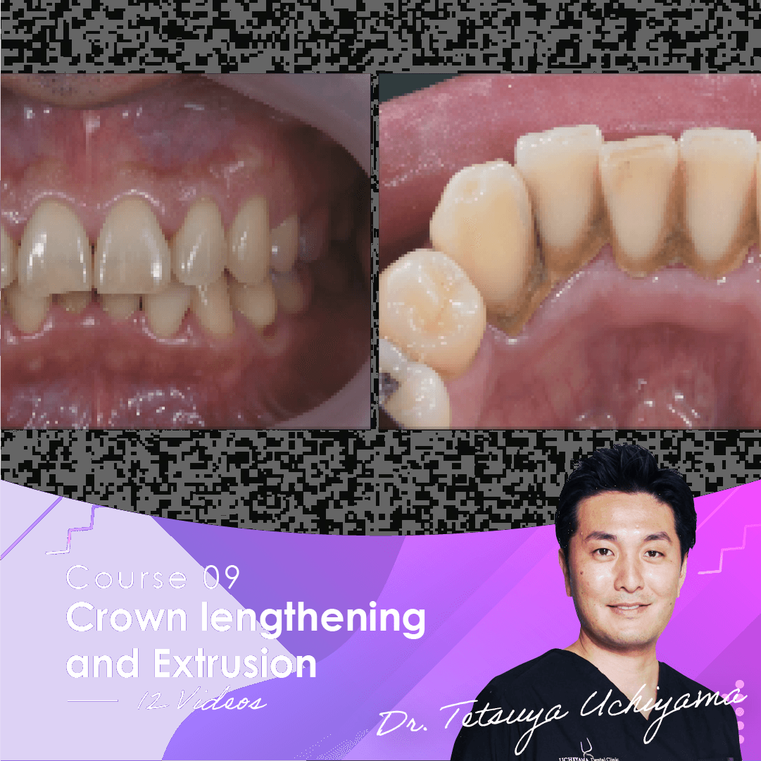 Crown lengthening and Extrusion