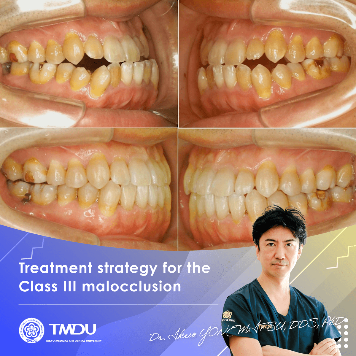 Treatment strategy for the Class III malocclusion