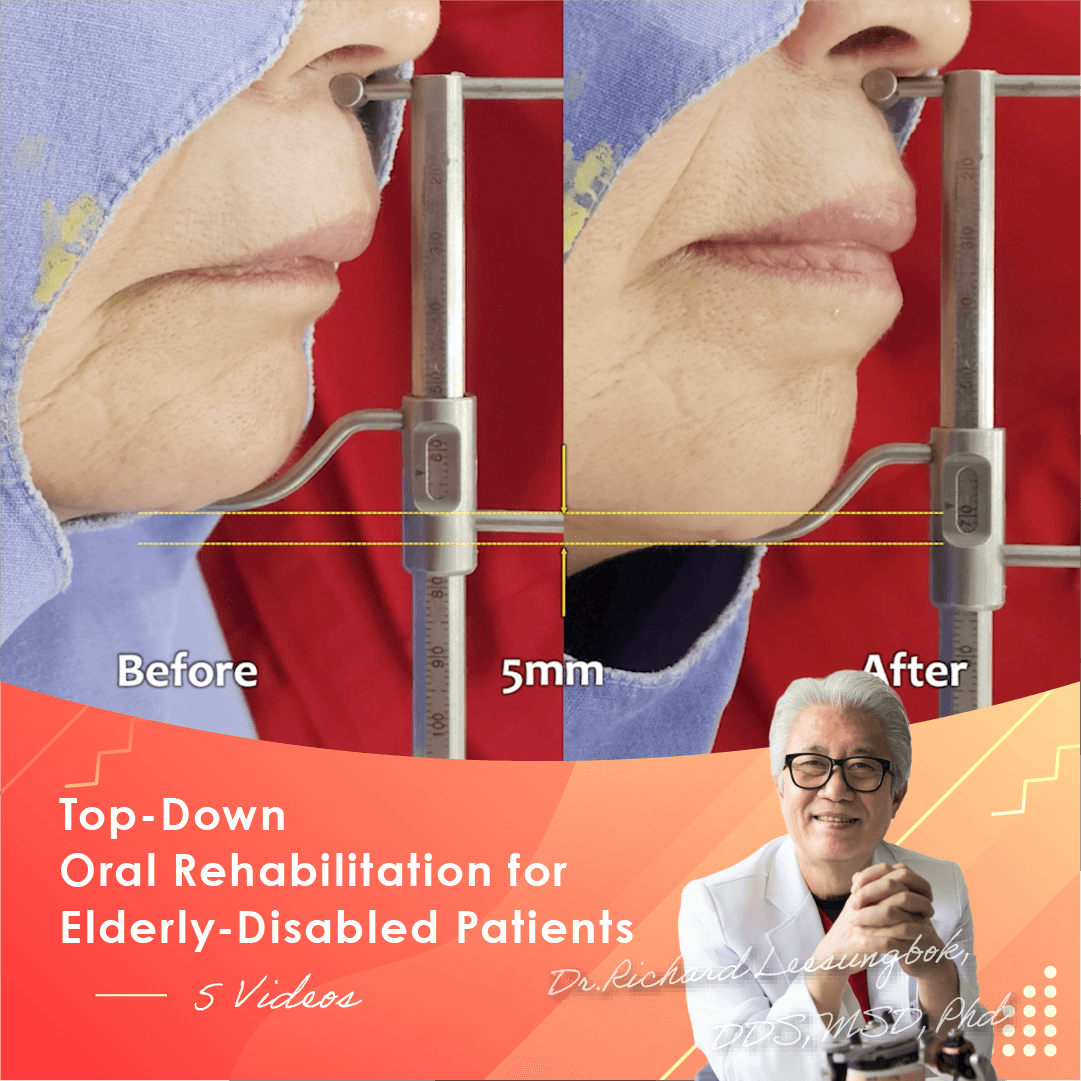 Top-Down Oral Rehabilitation for Elderly-Disabled Patients