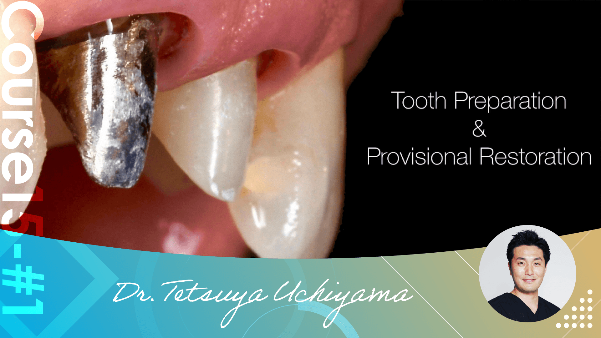 #1 Tooth Preparation Requirements