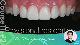 #2 Digital Dentistry enabling thinnest provisional restorations